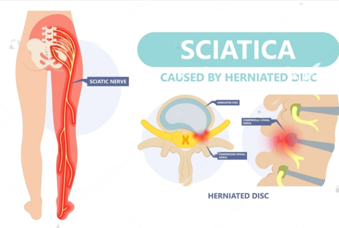 Sciatica Pain Treatment