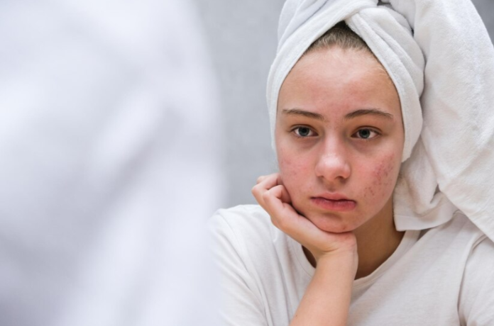 Best Skincare Routines for Acne